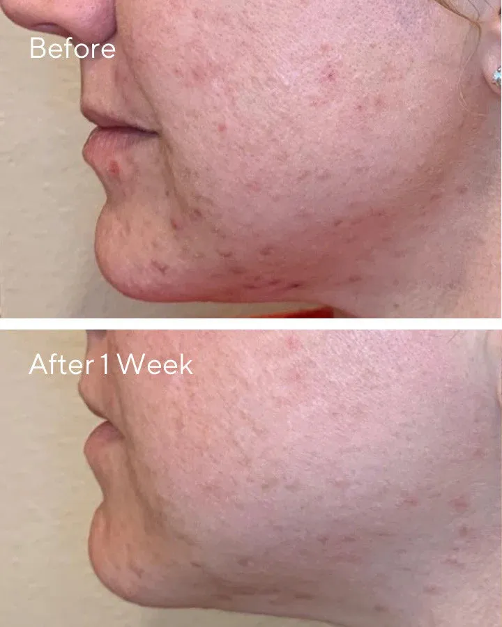 AHA/BHA/Retinoid Daily Clarifying Peel